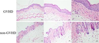 The Gut Bacteria Dysbiosis Contributes to Chronic Graft-Versus-Host Disease Associated With a Treg/Th1 Ratio Imbalance